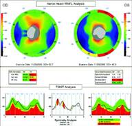 tomografia optica coherente en glaucoma